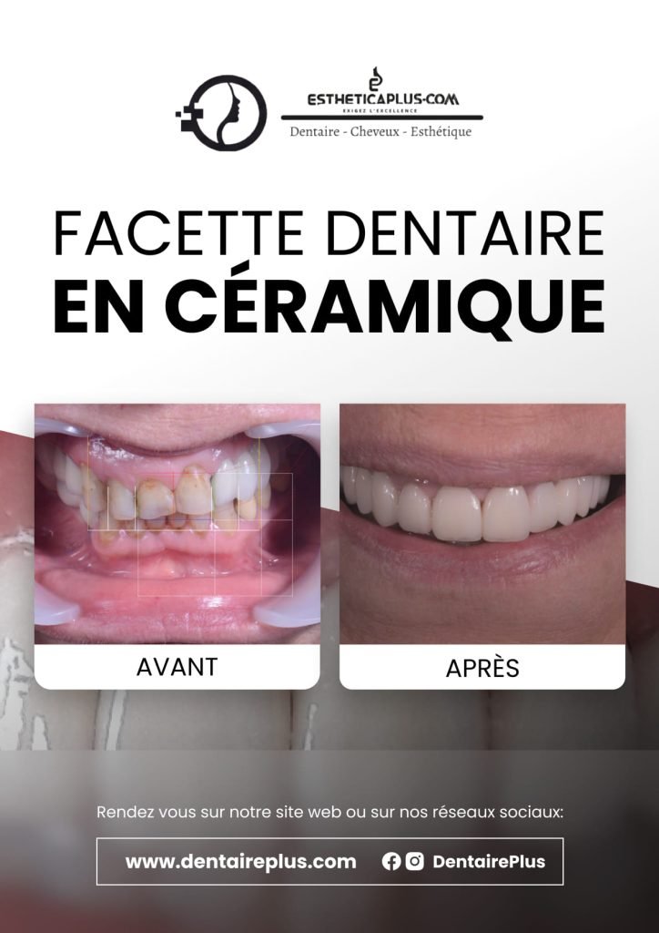 facette céramique Tanger, Tétouan. clinique