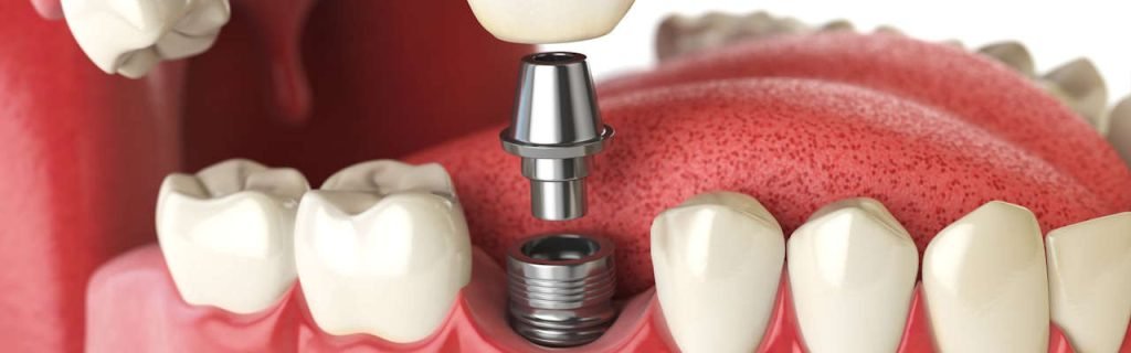bridge sur implants à Tanger pas chère