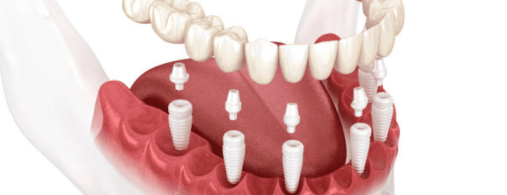 Prothèse sur implant All on 6 a Tanger