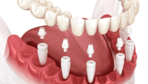 Tout Savoir sur les Prothèses Dentaires All-on-4 et All-on-6 : Une Solution Révolutionnaire pour un Sourire Complet